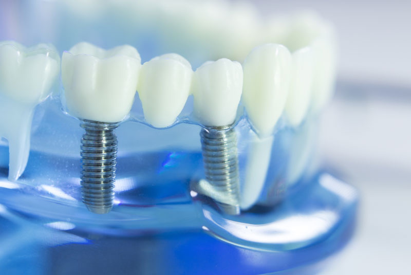 dental implants for multiple missing teeth