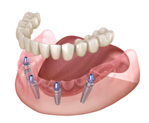 an image of full mouth dental implants in Chico, CA.