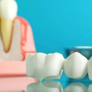 how do dental implants work