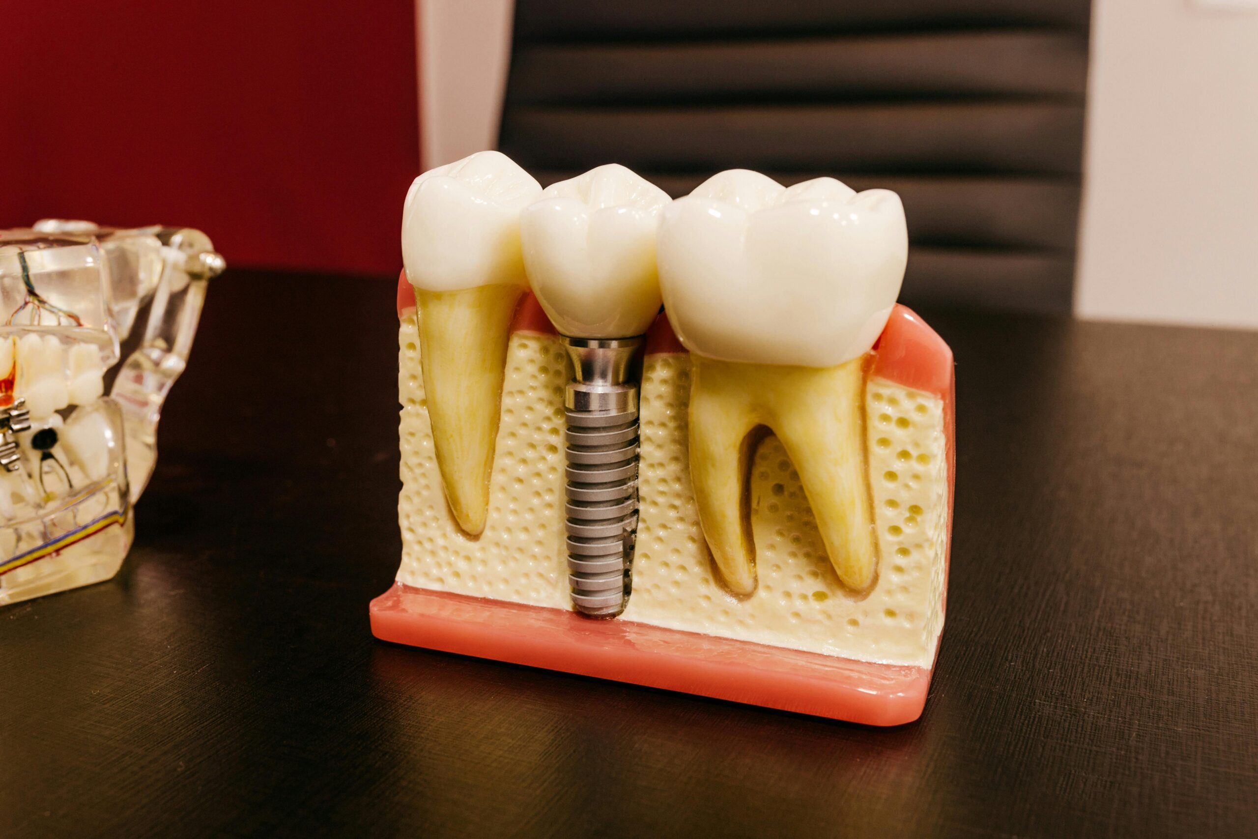 what are dental implants made of